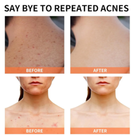 Crème visage anti‑acné 24h Mooyam – 100g – Image 2